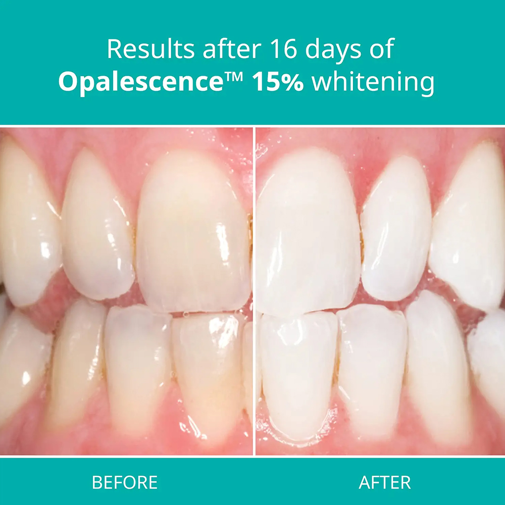 طقم تبييض احترافي من Opalescen - مراجعة Teeth Whitening Gel Refills وسعره