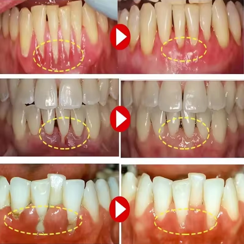جل تبييض الأسنان للعناية باللث - مراجعة Teeth Whitening Gel وسعره
