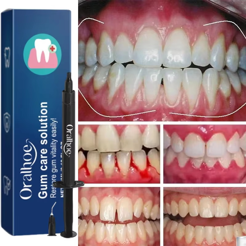 جل تبييض الأسنان للعناية باللث - مراجعة Teeth Whitening Gel وسعره
