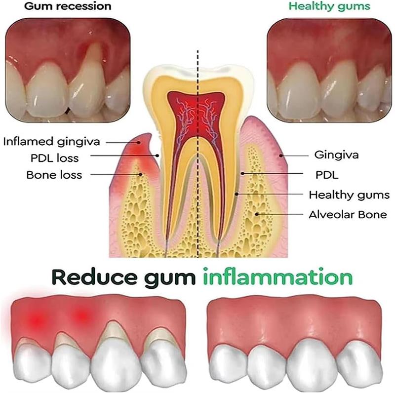 جل تبييض الأسنان للعناية باللث - مراجعة Teeth Whitening Gel وسعره
