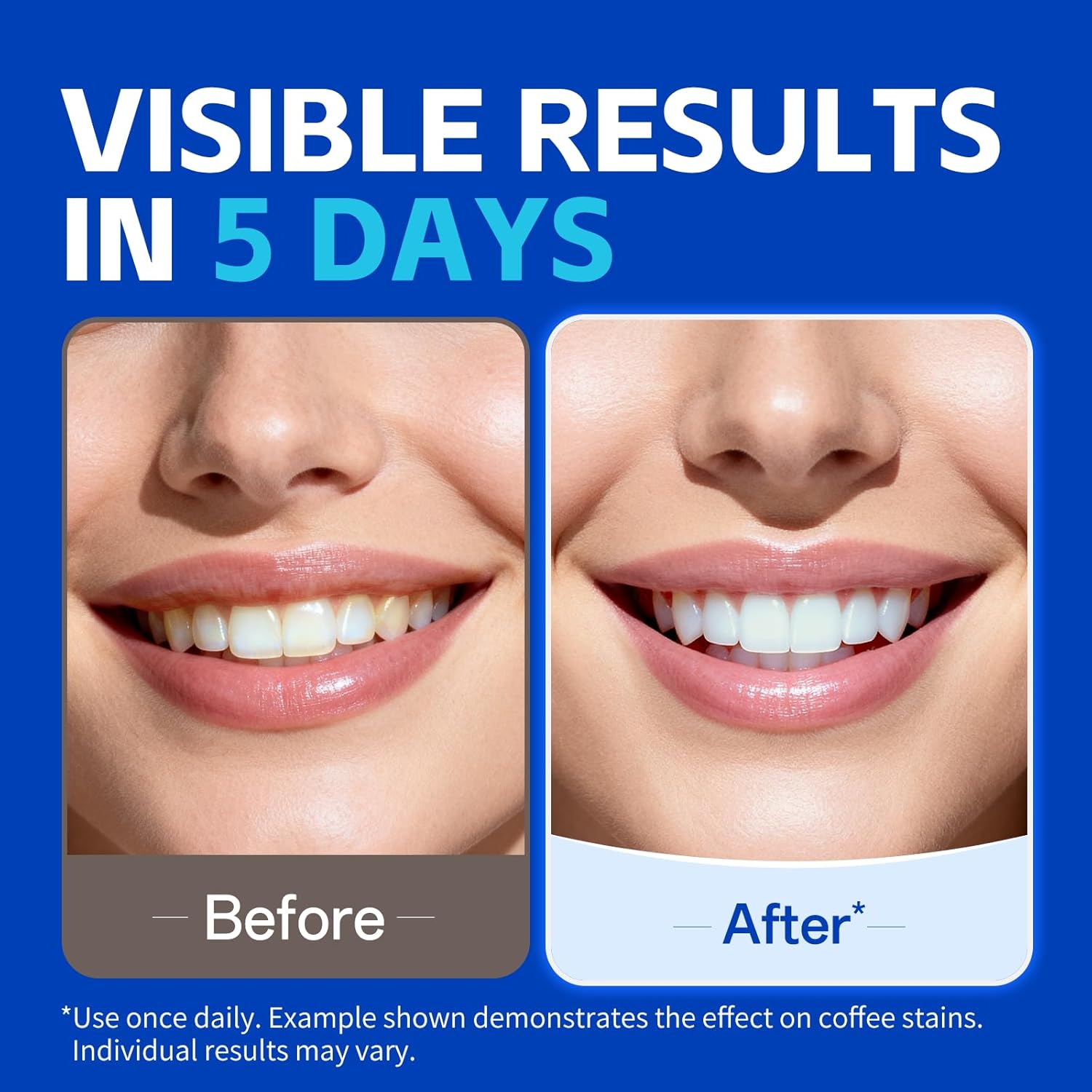شرائط تبييض الأسنان (1/7 زوج)  - مراجعة Teeth Whitening Retainer وسعره
