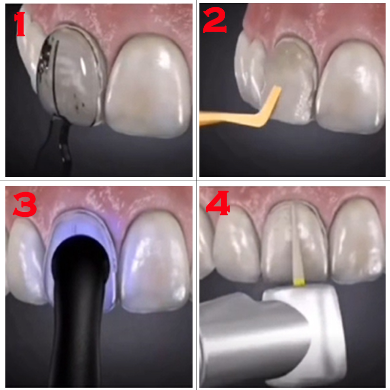 قالب أسنان لقشور الراتنج المرك - مراجعة Teeth Whitening Lab وسعره