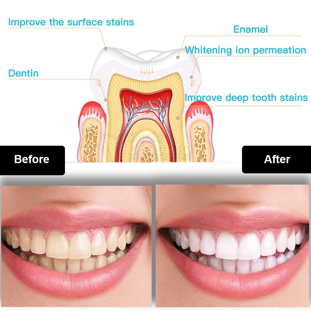 طقم تبييض الأسنان صغير 16 LED  - مراجعة Teeth Whitening Q&M وسعره